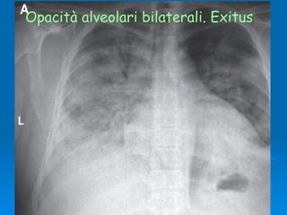 Opacità alveolari bilaterali. Exitus  
