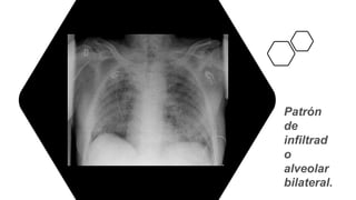 Patrón
de
infiltrad
o
alveolar
bilateral.
 