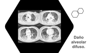 Daño
alveolar
difuso.
 