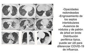 -Opacidades
redondeadas
-Engrosamiento de
los septos
interlobulares
-Ausencia de
nódulos y de patrón
de árbol en brote
Distribución
periférica típica,
puede ser útil para
diferenciar COVID-19
de influenza.
 