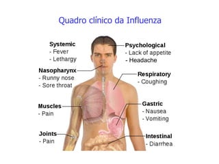 Quadro clínico da Influenza
- Headache
 