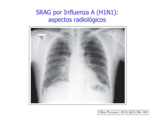 SRAG por Influenza A (H1N1):
aspectos radiológicos
 