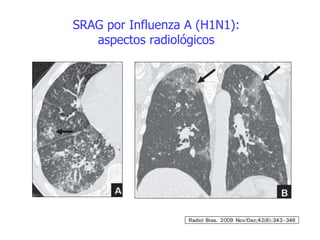 SRAG por Influenza A (H1N1):
aspectos radiológicos
 