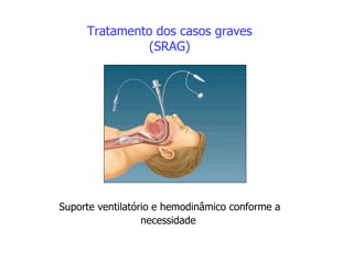 Tratamento dos casos graves
(SRAG)
Suporte ventilatório e hemodinâmico conforme a
necessidade
 