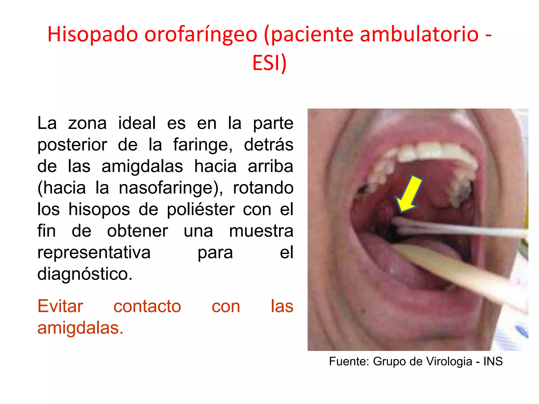 Hisopado orofaríngeo (paciente ambulatorio -
ESI)
La zona ideal es en la parte
posterior de la faringe, detrás
de las amigdalas hacia arriba
(hacia la nasofaringe), rotando
los hisopos de poliéster con el
fin de obtener una muestra
representativa para el
diagnóstico.
Evitar contacto con las
amigdalas.
Fuente: Grupo de Virologia - INS
 