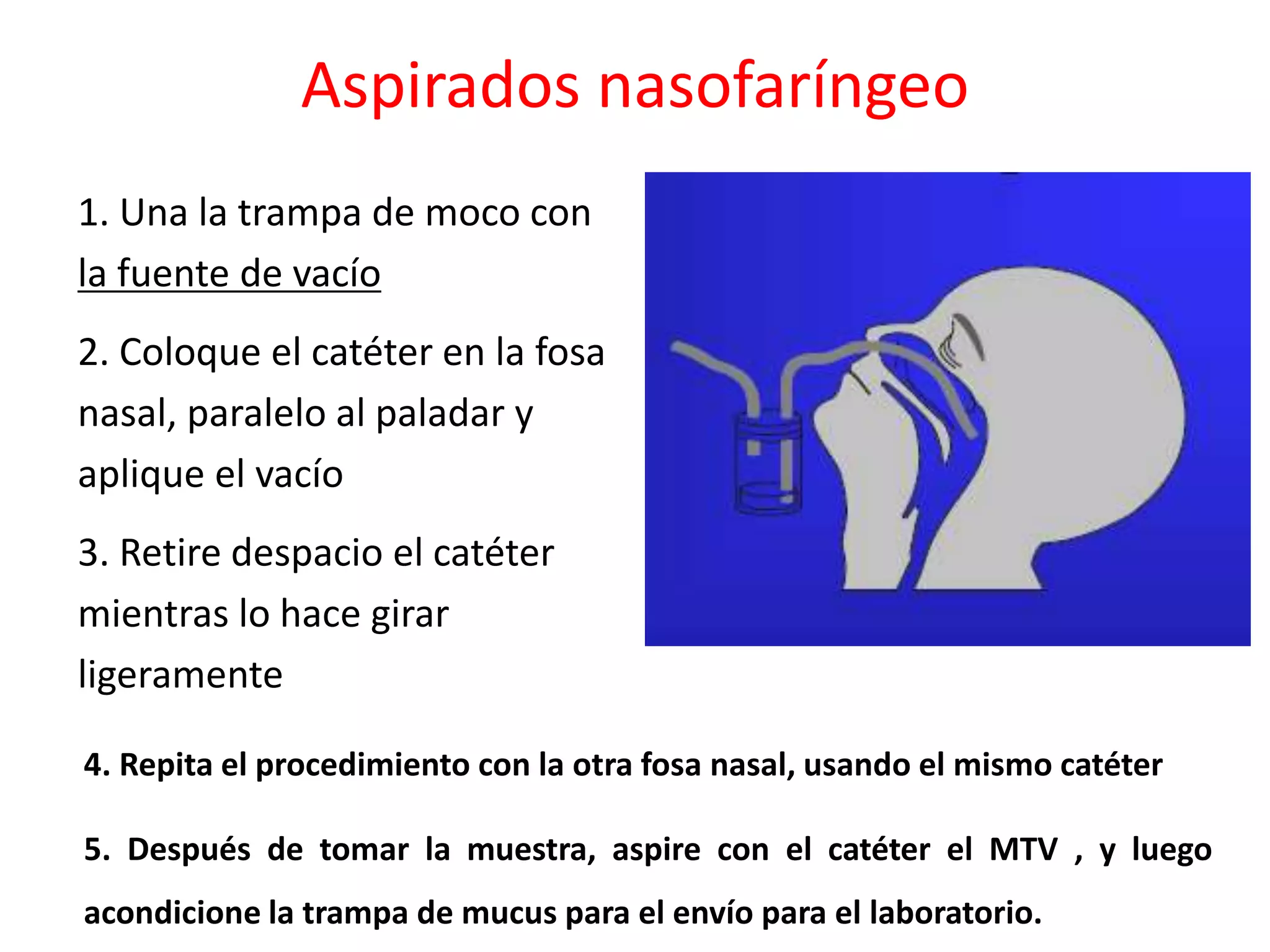 Aspirados nasofaríngeo
1. Una la trampa de moco con
la fuente de vacío
2. Coloque el catéter en la fosa
nasal, paralelo al paladar y
aplique el vacío
3. Retire despacio el catéter
mientras lo hace girar
ligeramente
4. Repita el procedimiento con la otra fosa nasal, usando el mismo catéter
5. Después de tomar la muestra, aspire con el catéter el MTV , y luego
acondicione la trampa de mucus para el envío para el laboratorio.
 