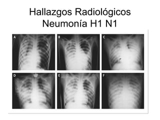 Hallazgos Radiol ógicos Neumon ía  H1 N1 