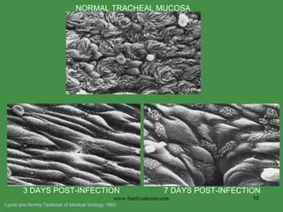 NORMAL TRACHEAL MUCOSA 3 DAYS POST-INFECTION 7 DAYS POST-INFECTION Lycke and Norrby Textbook of Medical Virology 1983 www.freelivedoctor.com 