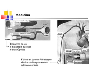 Medicina
Esquema de un
Fibrascopio que usa
Fibras Ópticas
Forma en que un Fibrascopio
elimina un bloqueo en una
arteria coronaria
 