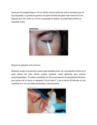 hasta que la humedad llegue a 10 mm (límite normal a partir del cual se considera que no
hay sequedad). La prueba es positiva si la parte húmeda del papel mide menos de 5 mm
después de 5 min. Entre 5 y 10 mm la sequedad es dudosa. Su positividad confirma la
sequedad ocular.
Biopsia de glándula salival menor
Mediante cirugía mínimamente invasiva bajo anestesia local, con una pequeña incisión en la
parte interna del labio inferior pueden extraerse varias glándulas para examen
anatomopatológico . El criterio compatible con SS es la presencia de sialoadenitis linfocítica,
que requiere de al menos un agregado (“focus score”≥ 1) de al menos 50 linfocitos en una
superficie de 4 mm 2en áreas periductales o perivasculares
 