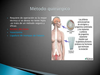    Requiere de operación es la mejor
    técnica si se desea no tener hijos
    ,se trata de un método seguro y
    eficaz.
   Existen dos tipos:
   Vasectomía
   Ligadura de trompas de Falopio
 