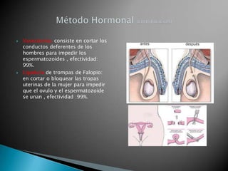    Vasectomía: consiste en cortar los
    conductos deferentes de los
    hombres para impedir los
    espermatozoides , efectividad:
    99%.
   Ligadura de trompas de Falopio:
    en cortar o bloquear las tropas
    uterinas de la mujer para impedir
    que el ovulo y el espermatozoide
    se unan , efectividad :99%.
 