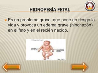 HIDROPESÍA FETAL
 Es un problema grave, que pone en riesgo la
vida y provoca un edema grave (hinchazón)
en el feto y en el recién nacido.
Siguiente
 