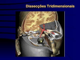 Dissecções Tridimensionais
 