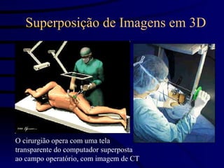 Superposição de Imagens em 3D




O cirurgião opera com uma tela
transparente do computador superposta
ao campo operatório, com imagem de CT
 