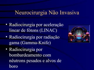 Neurocirurgia Não Invasiva

• Radiocirurgia por aceleração
  linear de fótons (LINAC)
• Radiocirurgia por radiação
  gama (Gamma-Knife)
• Radiocirurgia por
  bombardeamento com
  nêutrons pesados e alvos de
  boro
 