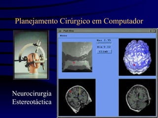 Planejamento Cirúrgico em Computador




Neurocirurgia
Estereotáctica
 
