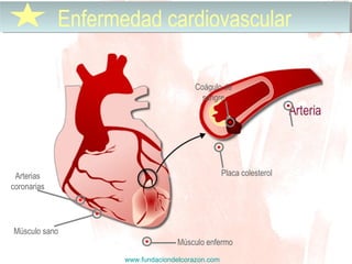 www.fundaciondelcorazon.com
Enfermedad cardiovascularEnfermedad cardiovascular
Placa colesterolArterias
coronarias
Coágulo de
sangre
Músculo sano
Músculo enfermo
 