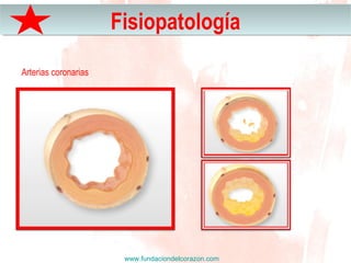 www.fundaciondelcorazon.com
FisiopatologíaFisiopatología
Arterias coronarias
 