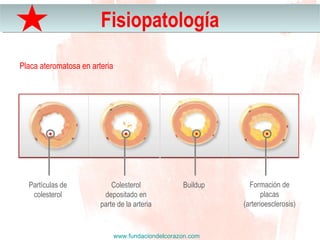 www.fundaciondelcorazon.com
FisiopatologíaFisiopatología
Placa ateromatosa en arteria
Formación de
placas
(arterioesclerosis)
Partículas de
colesterol
Colesterol
depositado en
parte de la arteria
Buildup
 