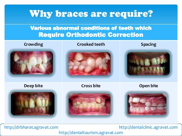 different types of braces