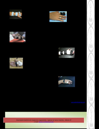 Órtese do tipo Cock- up

                                                                                                       Órtese para dedo em martelo
  Indicação: Utilizada em várias patologias sendo elas neurológicas      Indicação: O tratamento do dedo martelo depende do tempo
                                                                         de lesão e grau de deformidade em flexão.
  e/ou ortopédicas.
                                                                         Obj: Recomenda-se a imobilização interrupta por 6 a 8
  Obj: Estabilizar, prevenir e corrigir o desempenho funcional da mão.   semanas.



                                                                         Órtese modelo funcional

                                                                         Indicação:Utilizadas para patologias neurológicas e
                                                                         ortopédicas.
                               Órtese dinâmica de punho                  Objetivo: Manutenção do arco funcional da mão e prevenção
                                                                         das deformidades.
  Indicação: Para ganho da extensão e flexão do punho.
  Obj: Restaurar a amplitude dos movimentos perdidos após
  uma lesão e/ou fratura.




                                                                         Órtese de nervo ulnar

                                                                         Indicação: Indicadas para lesões do nervo ulnar.
                         Órtese dinâmica para rigidez da falange
                                                                         Objetivo: Para correção da musculatura intrínseca da mão e
  proximal
                                                                         restaurar a flexão das metacarpofalangiana causada pela
                                                                         lesão do nervo ulnar.
  Indicação: Para o uso em lesões tendinosas e fraturas de falange.
  Objetivo: Prevenção e correção de contratura muscular, rigidez
  articular e ganho de amplitude do movimento.




                                                                                             * Terapeuta ocupacional, CREFITO Nº11023
                                                                                                                        Terapia da Mão
                                                                                                        Email: vera.lehm@hotmail.com



Obs.: A terapeuta ocupacional Vera Lehm foi à responsável pela confecção das órteses aqui ilustradas.




             Associação brasileira de terapeutas ocupacionais, regional de Santa Catarina – Abrato-SC
                                          e-mail: abrato-sc@hotmail.com
 