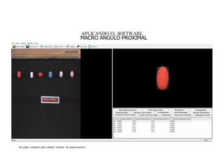 No pidas cantidad pide calidad “Análisis de medicamentos”.
APLICANDO EL SOFTWARE
MACRO ANGULO PROXIMAL
 