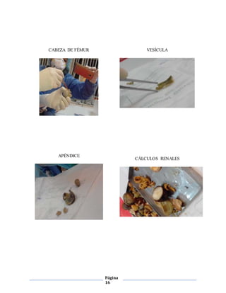 Página
16
CABEZA DE FÉMUR
APÉNDICE
VESÍCULA
CÁLCULOS RENALES
 