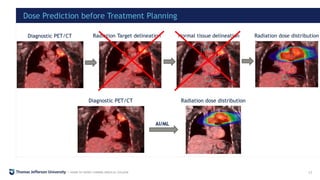Artificial Intelligence To Reduce Radiation-induced Cardiotoxicity In ...
