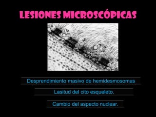 Lesiones microscópicas




 Desprendimiento masivo de hemidesmosomas

           Lasitud del cito esqueleto.

          Cambio del aspecto nuclear.
 