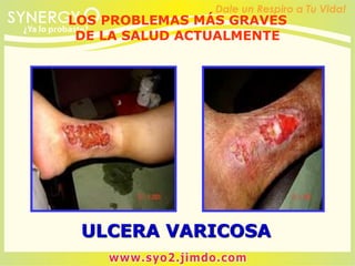 ULCERA VARICOSA
LOS PROBLEMAS MÁS GRAVES
DE LA SALUD ACTUALMENTE
 