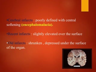 •Cerebral infarcts : poorly defined with central
softening (encephalomalacia).
•Recent infarcts : slightly elevated over the surface
•Old infarcts : shrunken , depressed under the surface
of the organ.
 