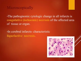 Microscopically
•The pathognomic cytologic change in all infarcts is
coagulative (ischaemic) necrosis of the affected area
of tissue or organ.
•In cerebral infarcts- characteristic
liquefactive necrosis.
 