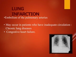 LUNG
INFARCTION
•Embolism of the pulmonary arteries
• May occur in patients who have inadequate circulation :
Chronic lung diseases
• Congestive heart failure.
 