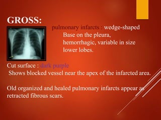 GROSS:
pulmonary infarcts : wedge-shaped
Base on the pleura,
hemorrhagic, variable in size
lower lobes.
Cut surface : dark purple
Shows blocked vessel near the apex of the infarcted area.
Old organized and healed pulmonary infarcts appear as
retracted fibrous scars.
 