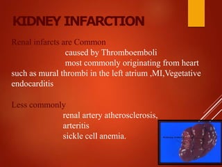 KIDNEY INFARCTION
Renal infarcts are Common
caused by Thromboemboli
most commonly originating from heart
such as mural thrombi in the left atrium ,MI,Vegetative
endocarditis
Less commonly
renal artery atherosclerosis,
arteritis
sickle cell anemia.
 
