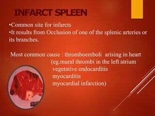 INFARCT SPLEEN
•Common site for infarcts
•It results from Occlusion of one of the splenic arteries or
its branches.
Most common cause : thromboemboli arising in heart
(eg.mural thrombi in the left atrium
vegetative endocarditis
myocarditis
myocardial infarction)
 