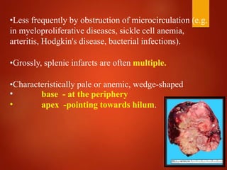 •Less frequently by obstruction of microcirculation (e.g.
in myeloproliferative diseases, sickle cell anemia,
arteritis, Hodgkin's disease, bacterial infections).
•Grossly, splenic infarcts are often multiple.
•Characteristically pale or anemic, wedge-shaped
•
•
base - at the periphery
apex -pointing towards hilum.
 
