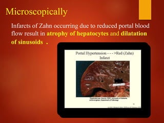 Microscopically
Infarcts of Zahn occurring due to reduced portal blood
flow result in atrophy of hepatocytes and dilatation
of sinusoids .
 