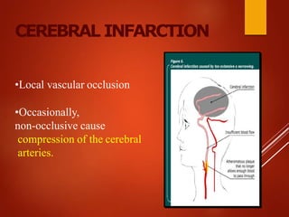 CEREBRAL INFARCTION
•Local vascular occlusion
•Occasionally,
non-occlusive cause
compression of the cerebral
arteries.
 