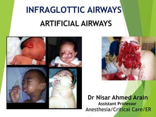 INFRAGLOTTIC AIRWAYS
ARTIFICIAL AIRWAYS
Dr Nisar Ahmed Arain
Assistant Professor
Anesthesia/Critical Care/ER
 