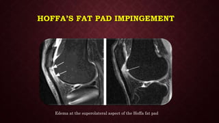 HOFFA’S FAT PAD IMPINGEMENT
Edema at the superolateral aspect of the Hoffa fat pad
 