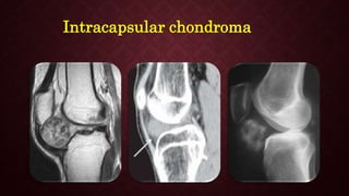 Intracapsular chondroma
 