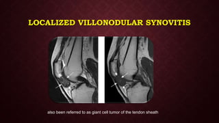 LOCALIZED VILLONODULAR SYNOVITIS
also been referred to as giant cell tumor of the tendon sheath
 