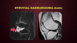 SYNOVIAL HAEMANGIOMA (RARE)
 