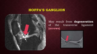 HOFFA’S GANGLION
May result from degeneration
of the transverse ligament
(arrows) .
 
