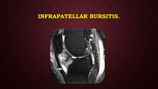 INFRAPATELLAR BURSITIS.
 