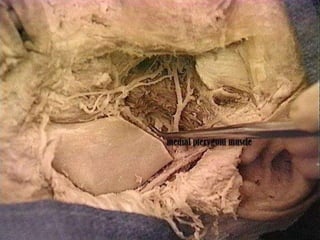 Medial pterygoid muscle
 