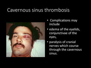 Cavernous sinus thrombosis
• Complications may
include
• edema of the eyelids,
conjunctivae of the
eyes,
• paralysis of cranial
nerves which course
through the cavernous
sinus.
 