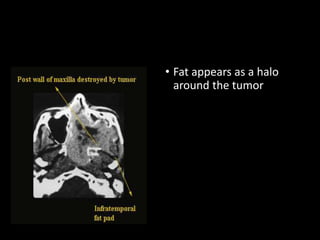 • Fat appears as a halo
around the tumor
 